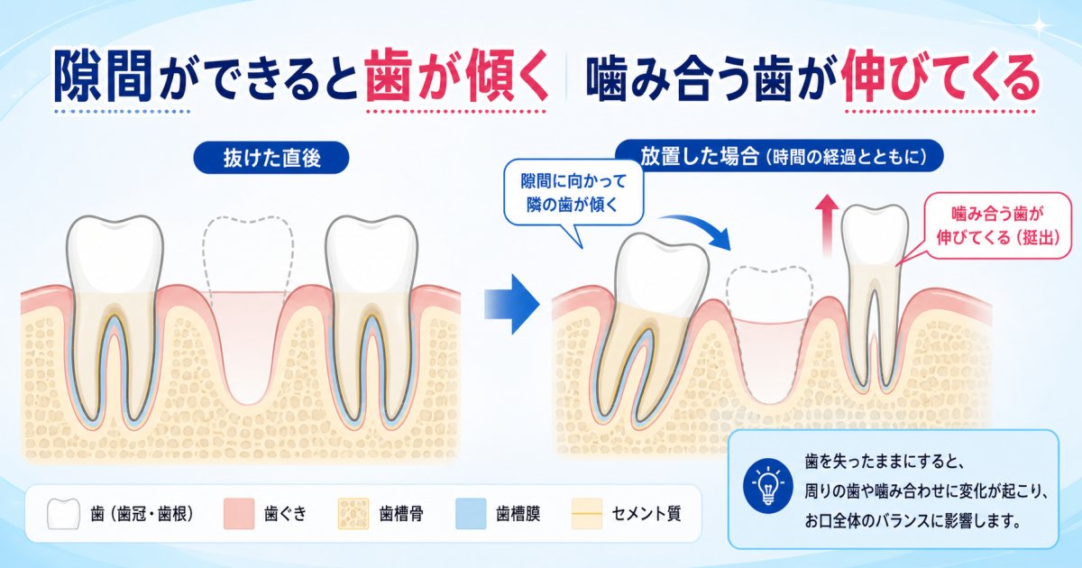 ぬけた奥歯を放置すると隣の歯が倒れる仕組みと主な影響