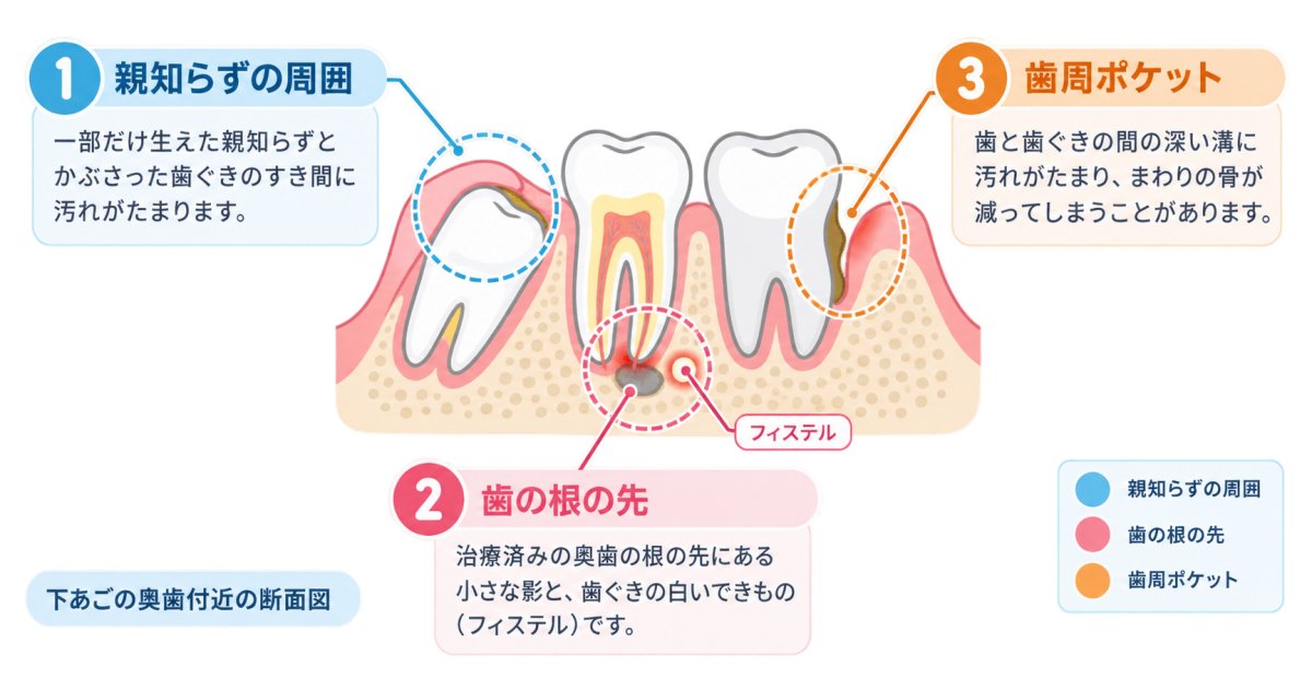奥歯の腫れが繰り返すのは、どこに炎症があるから?